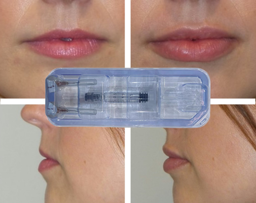 CE Injecteerbare Hyaluronzuur Filler Lip Injection 24 mg/ml