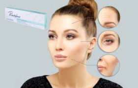 Hyaluronzuur huidfiller 1x1.1 ml lipfiller