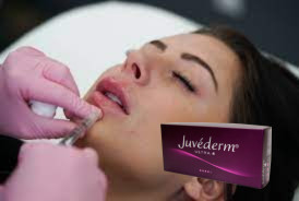 2 * 1 ml Juvederm Ultra 3 Lip Filler Hyaluronzuur Gel Fillers