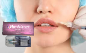 2 * 1 ml Juvederm Ultra 3 Lip Filler Hyaluronzuur Gel Fillers