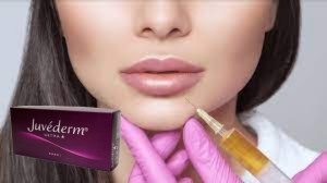 Juvederm Ultra 3 Hyaluronzuur HA Huidvuller 2 ml Lipvergroting