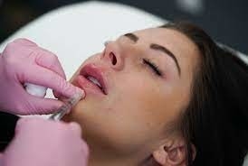 GMP Juvederm Ultra 3 HA huidvuller voor lippen Juvederm Vollure